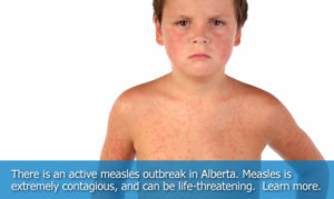 measles ad