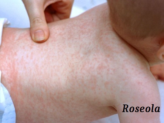 Roseola rash