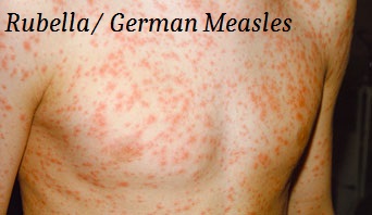 Rubella rash