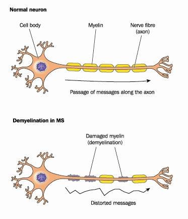 demyelination pic